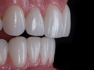 Veneers