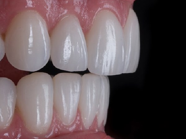 Ceramic veneers