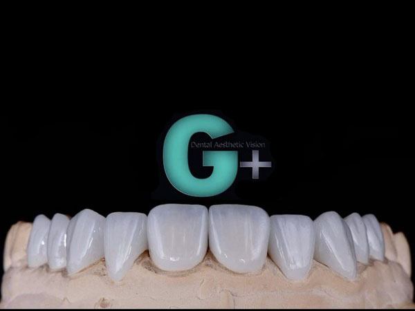 Emax veneers